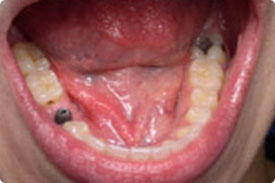 Dental Implant - Before