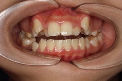 Open Bite Teeth