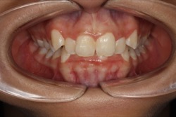 Overbite teeth