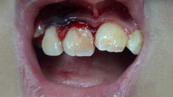 Trauma Teeth