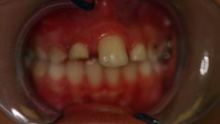 Paediatric - Teeth Problem