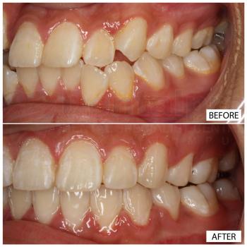 Fixed appliance metal