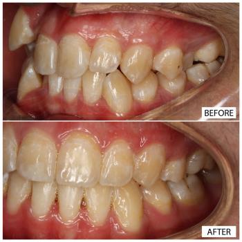 Fixed appliance metal