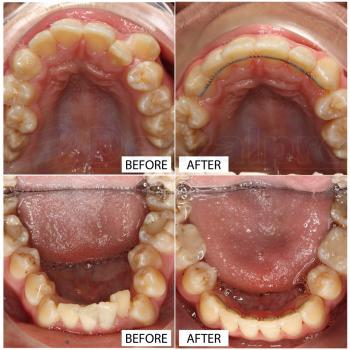 Fixed appliance metal