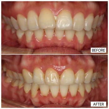 Fixed appliance ceramic