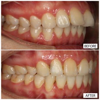 Fixed appliance ceramic