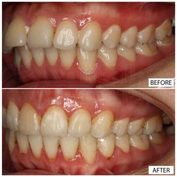 Fixed appliance ceramic