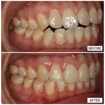 Invisalign