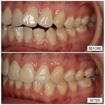 Invisalign